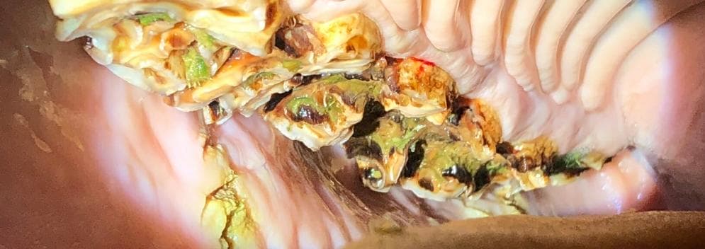 Peripheral caries improvement